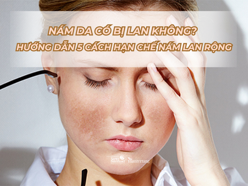 Nám da có bị lan không? Hướng dẫn 5 cách hạn chế nám lan rộng