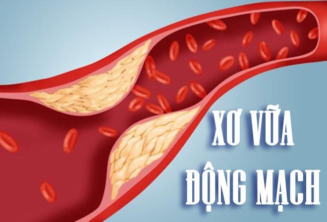 TẤT TẦN TẬT VỀ BỆNH XƠ VỮA ĐỘNG MẠCH MÀ BẠN NÊN BIẾT